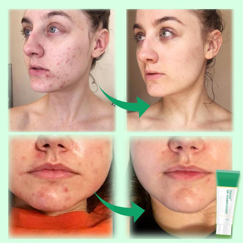 Limpiador para el tratamiento del acné Detox - Imagen 2