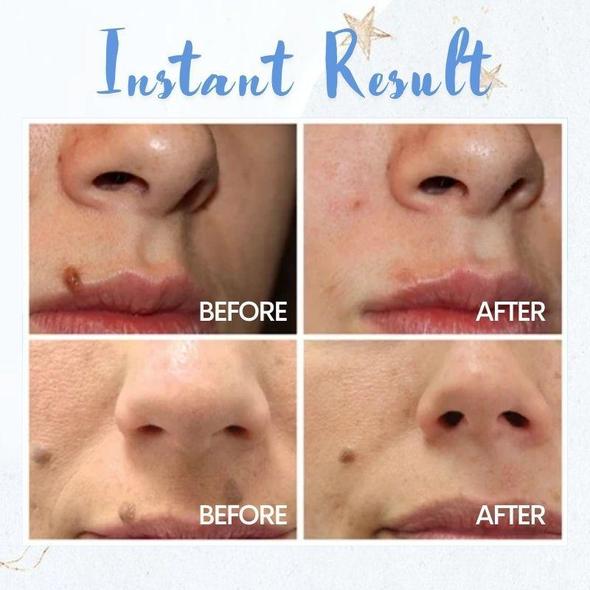 Pluma de eliminación de manchas - Imagen 2